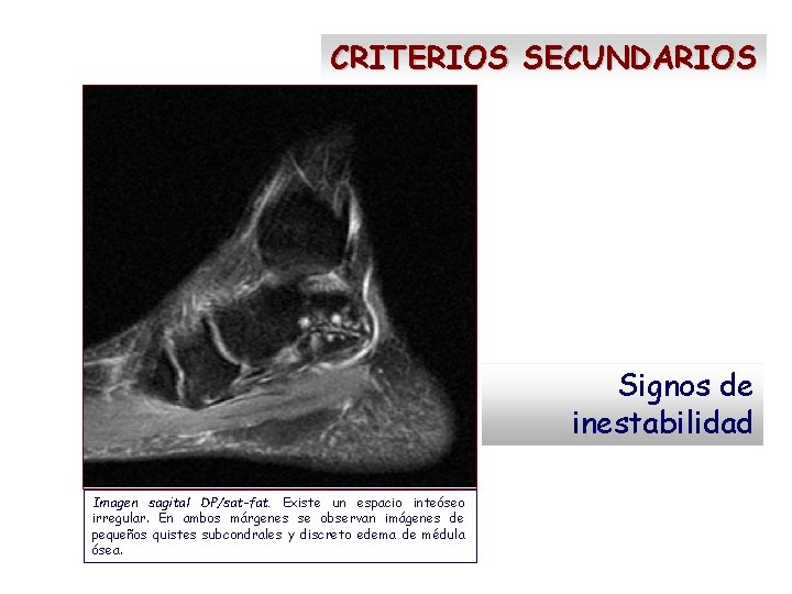 CRITERIOS SECUNDARIOS Signos de inestabilidad Imagen sagital DP/sat-fat. Existe un espacio inteóseo irregular. En