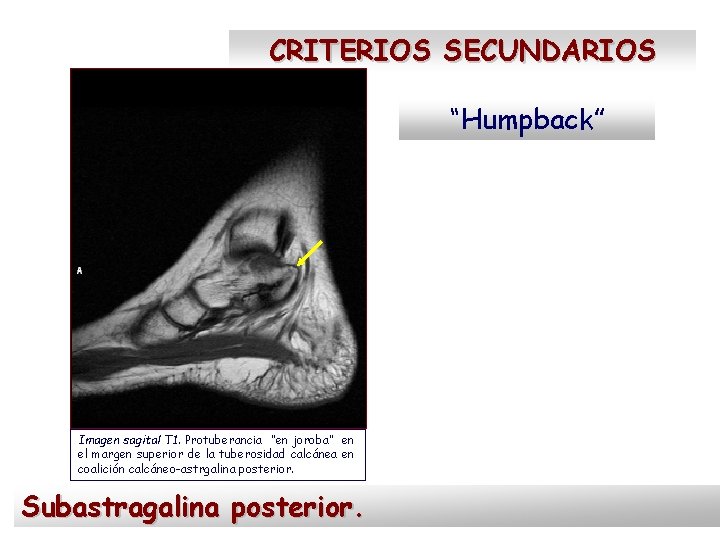 CRITERIOS SECUNDARIOS “Humpback” Imagen sagital T 1. Protuberancia “en joroba” en el margen superior