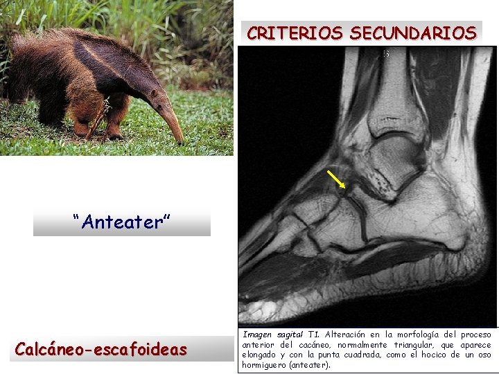CRITERIOS SECUNDARIOS “Anteater” Calcáneo-escafoideas Imagen sagital T 1. Alteración en la morfología del proceso