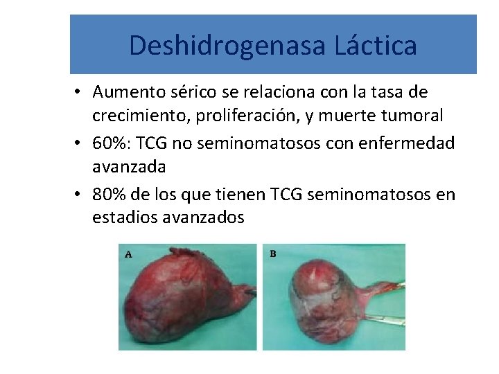 Deshidrogenasa Láctica • Aumento sérico se relaciona con la tasa de crecimiento, proliferación, y