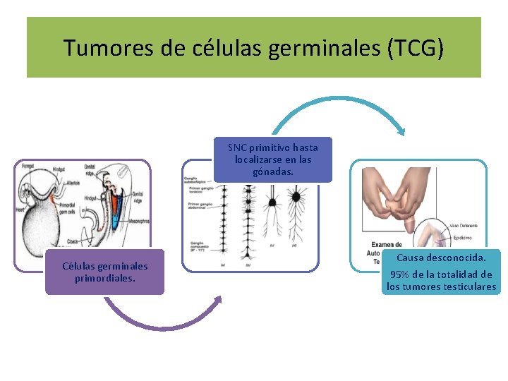 Tumores de células germinales (TCG) SNC primitivo hasta localizarse en las gónadas. Células germinales