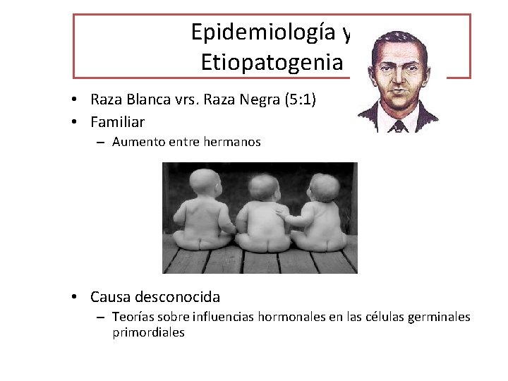 Epidemiología y Etiopatogenia • Raza Blanca vrs. Raza Negra (5: 1) • Familiar –