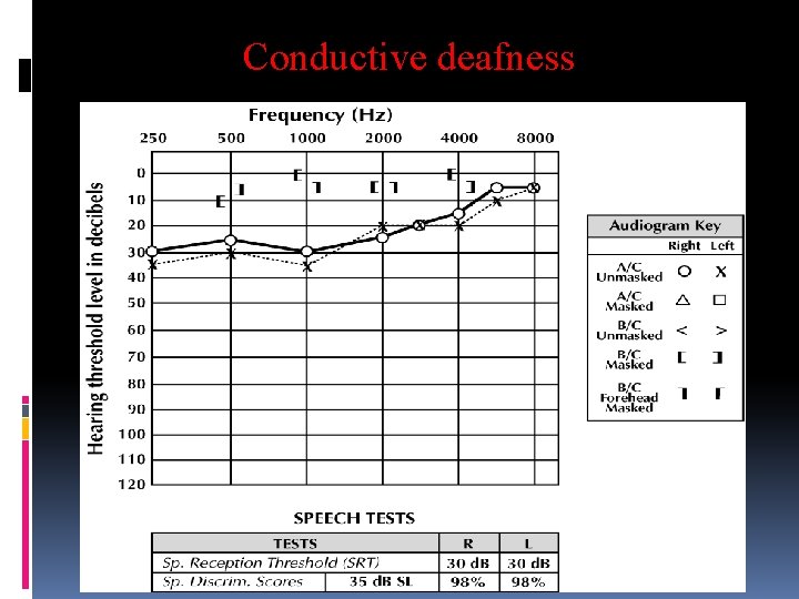 Conductive deafness 