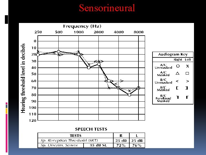 Sensorineural 