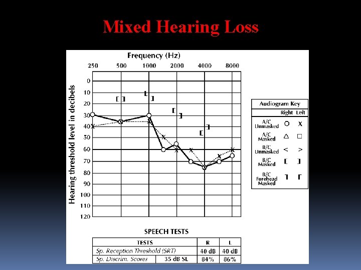 Mixed Hearing Loss 