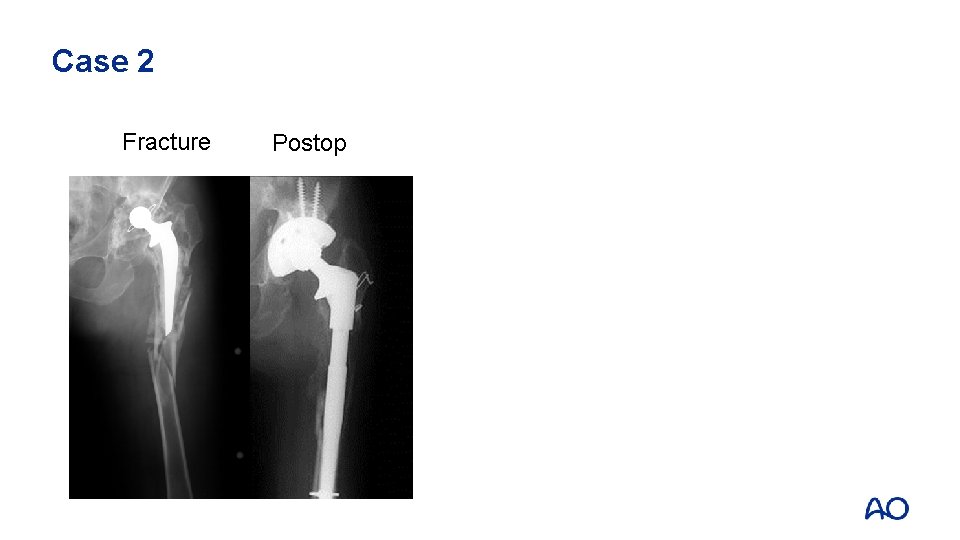 Fracturepatternfx fxof ofshaftfixationand anddesign Case 2 Fracture Case 10 5 4 2 Postop 