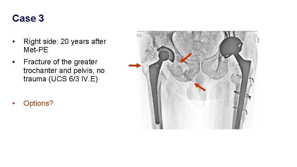 Case 3 • Right side: 20 years after Met-PE • Fracture of the greater