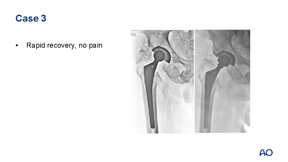 Case 3 • Rapid recovery, no pain 