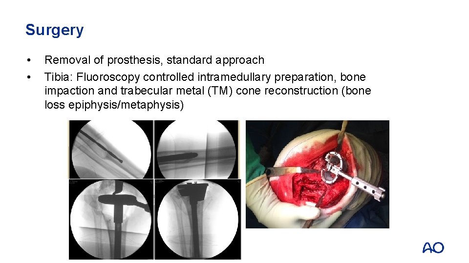 Surgery • • Removal of prosthesis, standard approach Tibia: Fluoroscopy controlled intramedullary preparation, bone