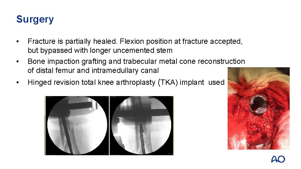 Surgery • • • Fracture is partially healed. Flexion position at fracture accepted, but