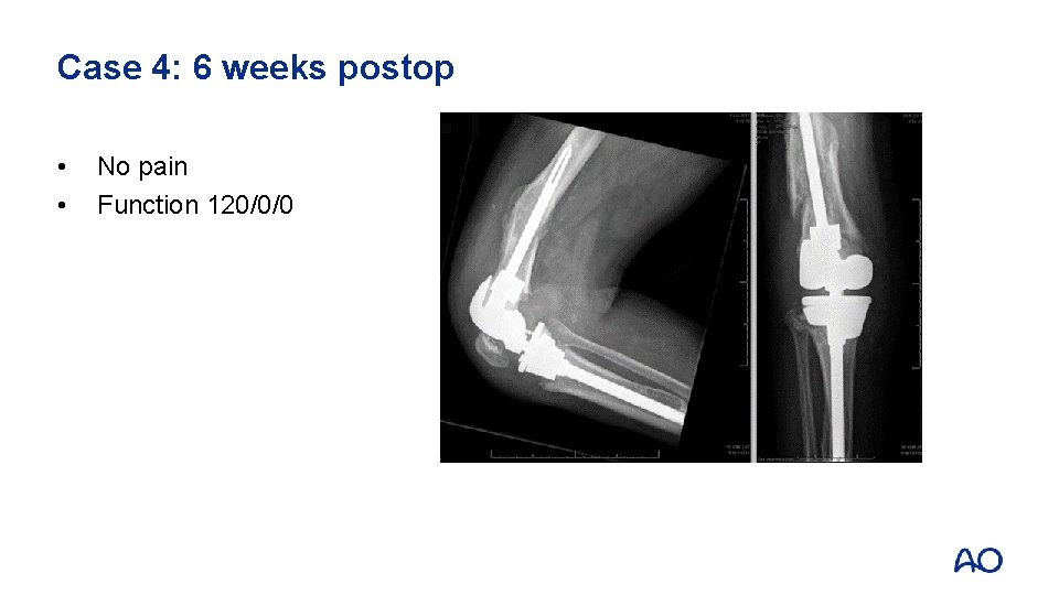 Case 4: 6 weeks postop • • No pain Function 120/0/0 