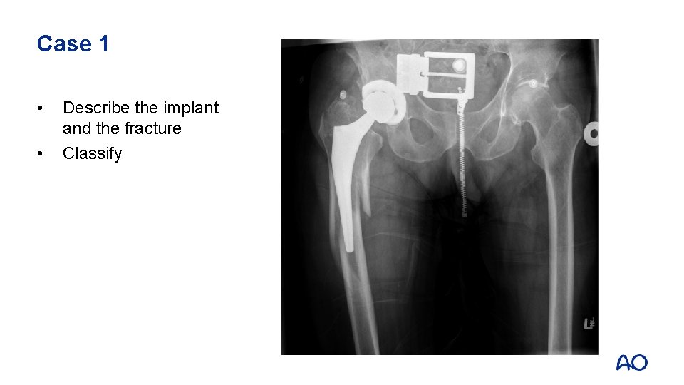 Case 1 • • Describe the implant and the fracture Classify 