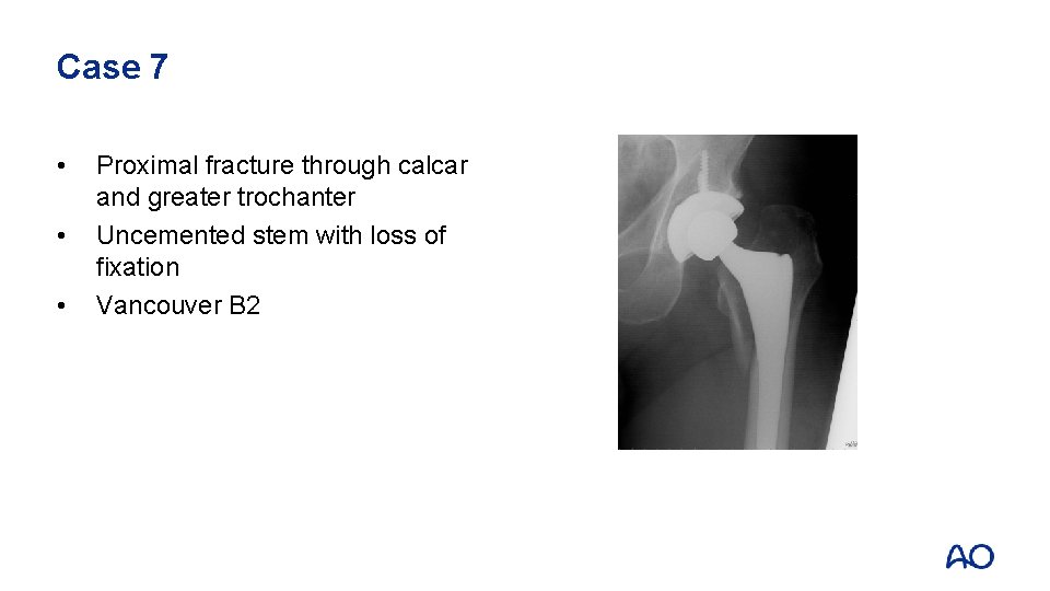 Case 7 • • • Proximal fracture through calcar and greater trochanter Uncemented stem