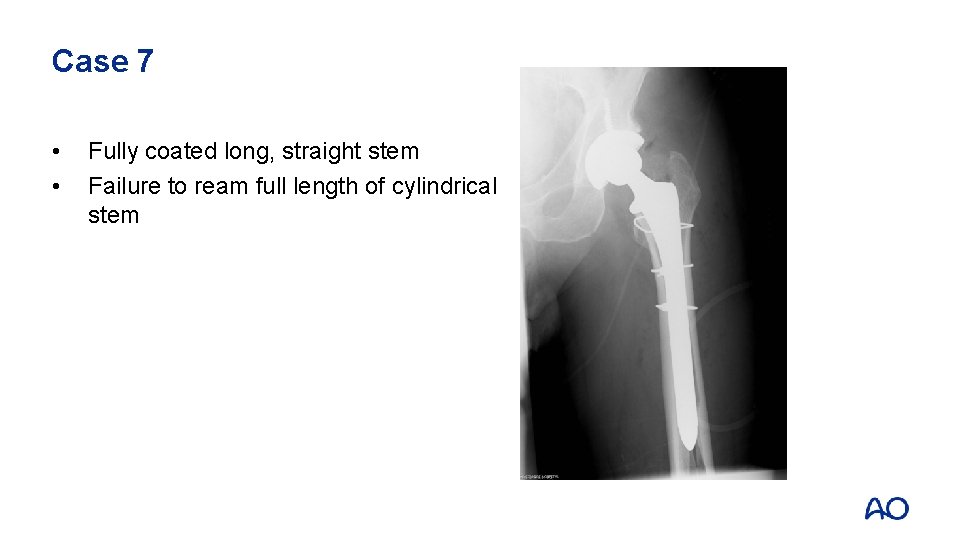 Case 7 • • Fully coated long, straight stem Failure to ream full length