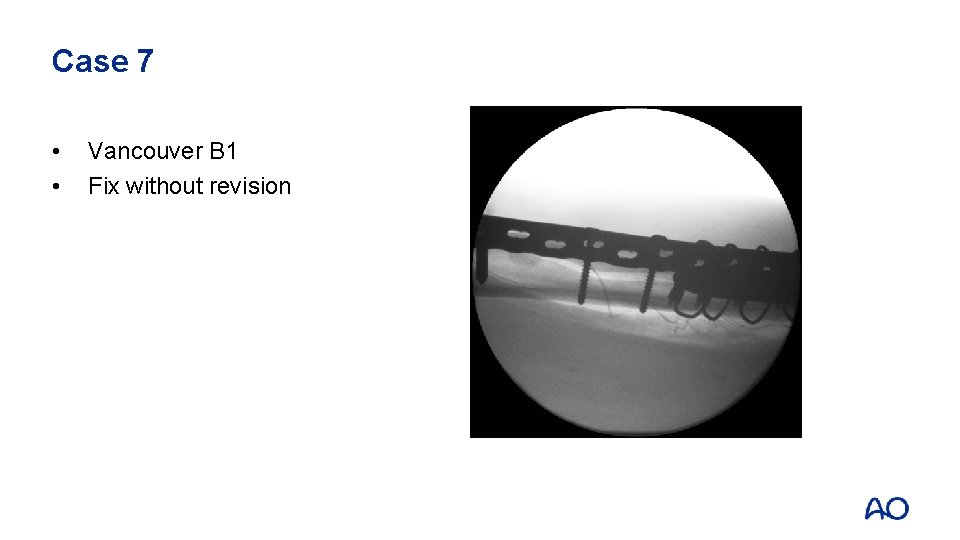 Case 7 • • Vancouver B 1 Fix without revision 