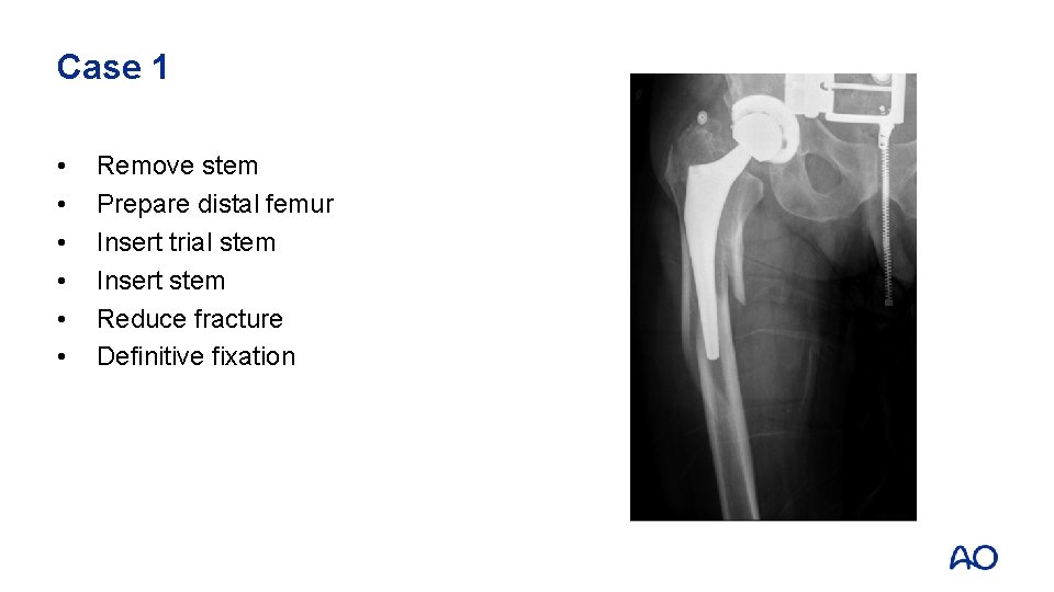 Case 1 • • • Remove stem Prepare distal femur Insert trial stem Insert