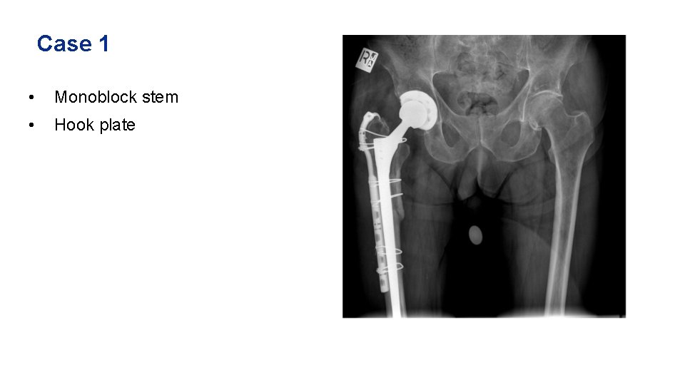 Case 1 • Monoblock stem • Hook plate 