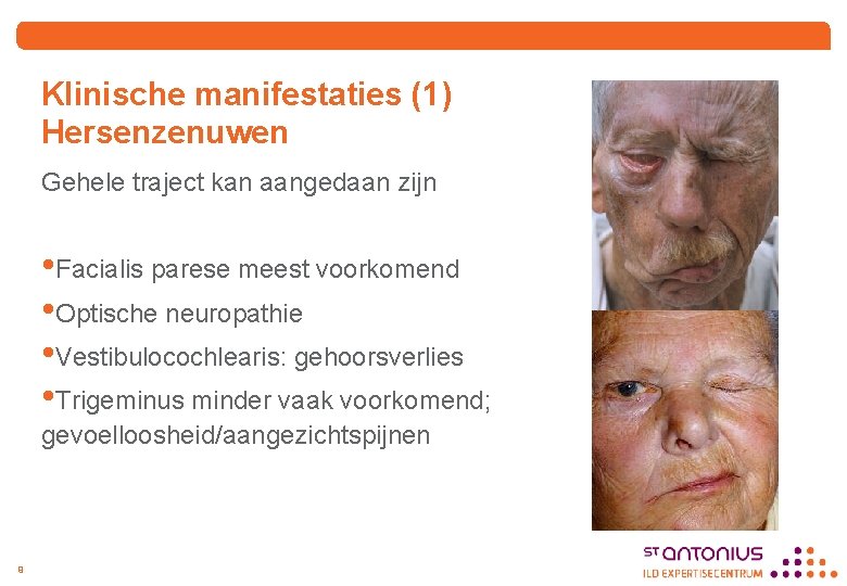 Klinische manifestaties (1) Hersenzenuwen Gehele traject kan aangedaan zijn • Facialis parese meest voorkomend