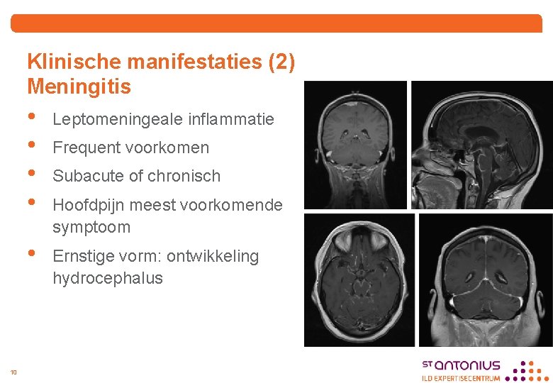 Klinische manifestaties (2) Meningitis 10 • • Leptomeningeale inflammatie • Ernstige vorm: ontwikkeling hydrocephalus