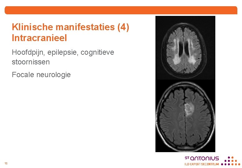 Klinische manifestaties (4) Intracranieel Hoofdpijn, epilepsie, cognitieve stoornissen Focale neurologie 12 