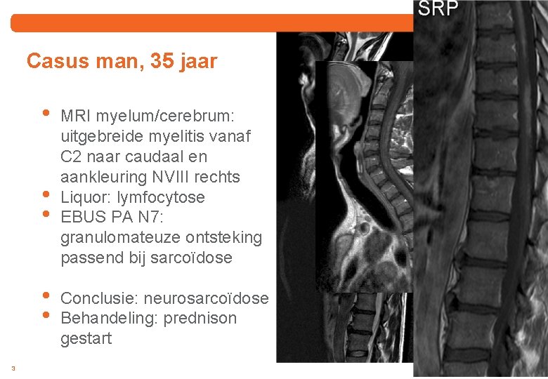 Casus man, 35 jaar • • • 3 MRI myelum/cerebrum: uitgebreide myelitis vanaf C