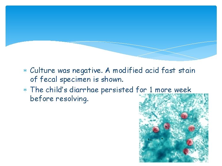 Culture was negative. A modified acid fast stain of fecal specimen is shown. Culture was negative. A modified acid fast stain of fecal specimen is shown.