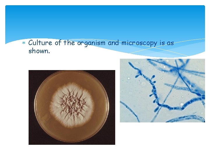 Culture of the organism and microscopy is as shown. Culture of the organism and microscopy is as shown.