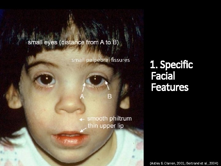 small palpebral fissures 1. Specific Facial Features (Astley & Clarren, 2001; Bertrand et al.