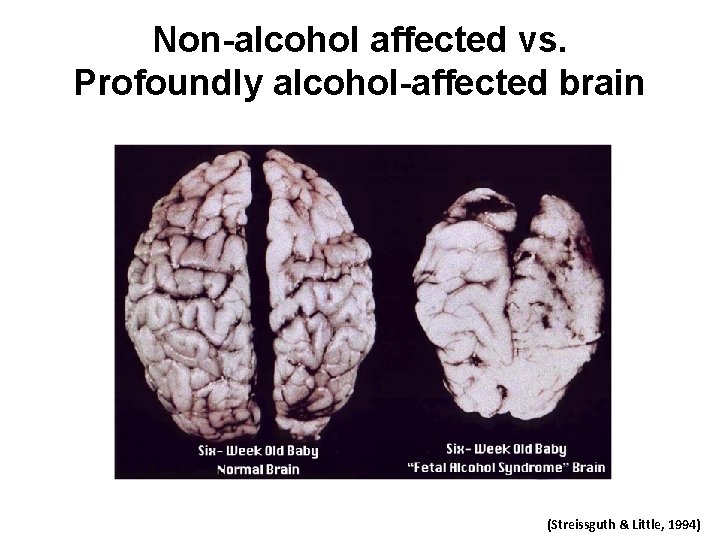 Non-alcohol affected vs. Profoundly alcohol-affected brain (Streissguth & Little, 1994) 