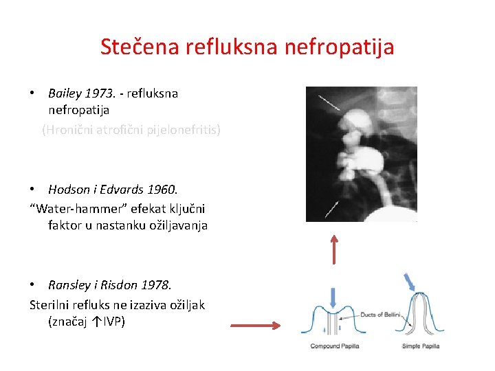 Stečena refluksna nefropatija • Bailey 1973. - refluksna nefropatija (Hronični atrofični pijelonefritis) • Hodson