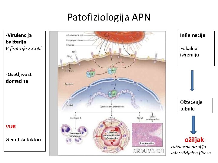 Patofiziologija APN -Virulencija bakterija P fimbrije E. Colli Inflamacija Fokalna ishemija -Osetljivost domaćina Oštećenje