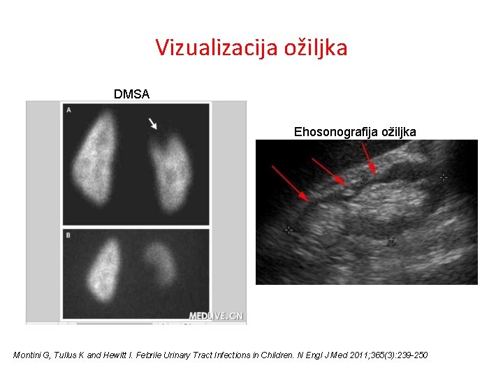 Vizualizacija ožiljka DMSA Ehosonografija ožiljka Montini G, Tullus K and Hewitt I. Febrile Urinary