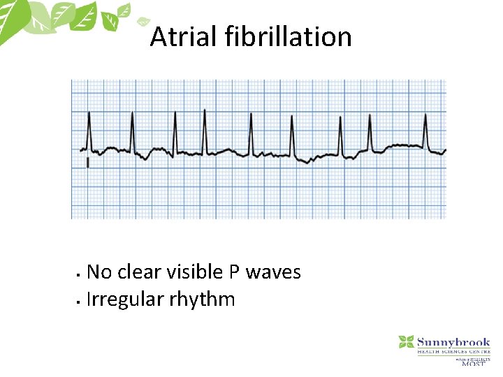 Atrial fibrillation No clear visible P waves § Irregular rhythm § 