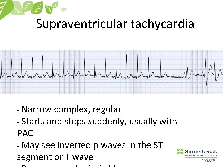 Supraventricular tachycardia Narrow complex, regular § Starts and stops suddenly, usually with PAC §