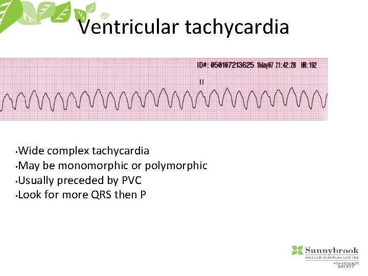 Ventricular tachycardia Wide complex tachycardia • May be monomorphic or polymorphic • Usually preceded