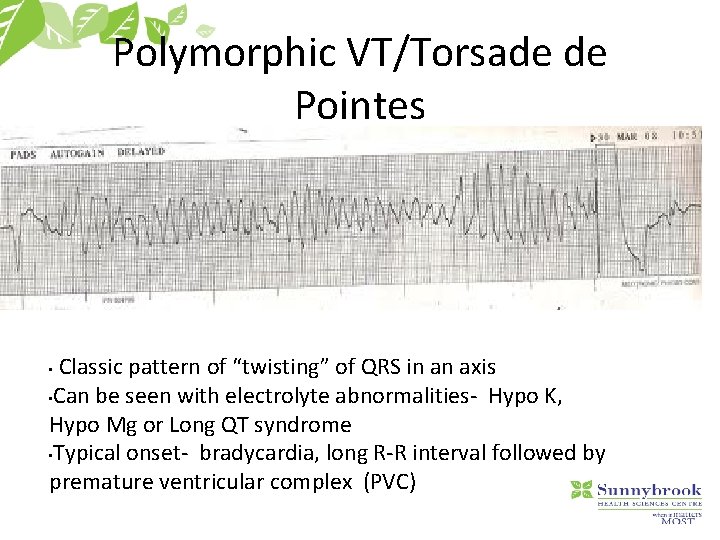Polymorphic VT/Torsade de Pointes Classic pattern of “twisting” of QRS in an axis •