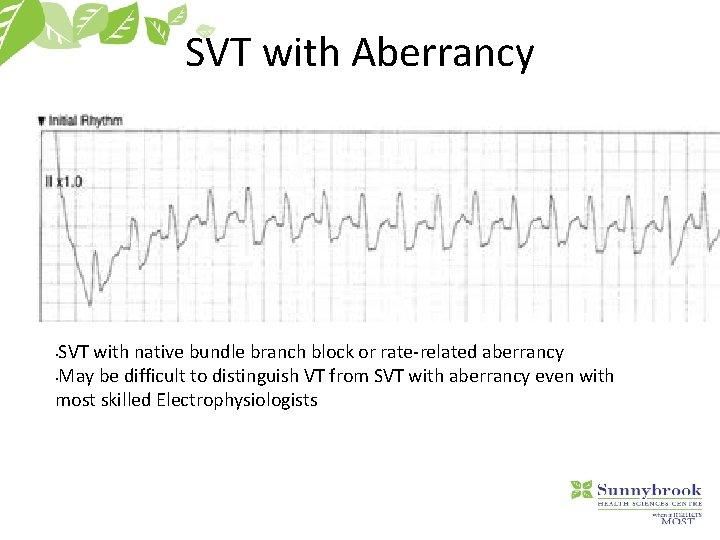 SVT with Aberrancy SVT with native bundle branch block or rate-related aberrancy • May