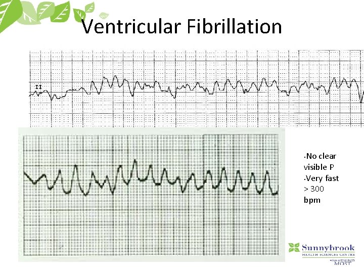 Ventricular Fibrillation No clear visible P §Very fast > 300 bpm § 