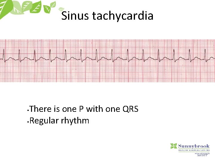 Sinus tachycardia There is one P with one QRS §Regular rhythm § 