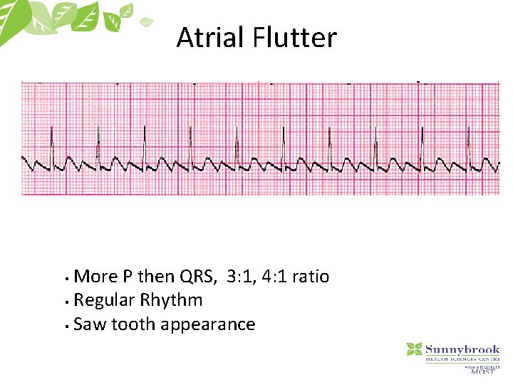 Atrial Flutter More P then QRS, 3: 1, 4: 1 ratio § Regular Rhythm