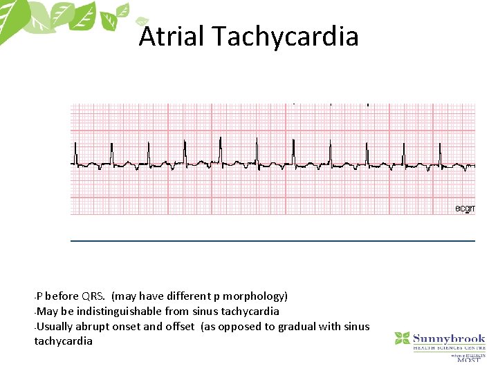 Atrial Tachycardia P before QRS. (may have different p morphology) • May be indistinguishable