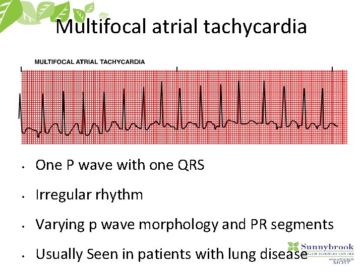 Multifocal atrial tachycardia • One P wave with one QRS • Irregular rhythm •