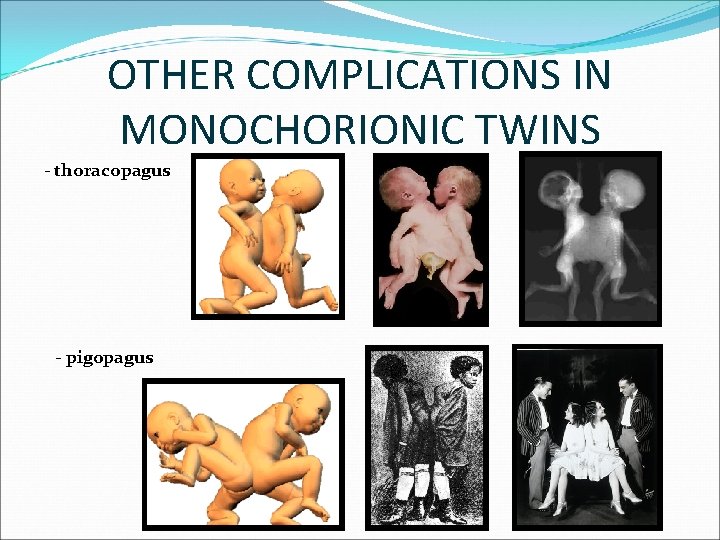 OTHER COMPLICATIONS IN MONOCHORIONIC TWINS - thoracopagus - pigopagus 