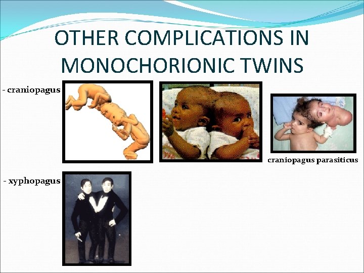 OTHER COMPLICATIONS IN MONOCHORIONIC TWINS - craniopagus parasiticus - xyphopagus 