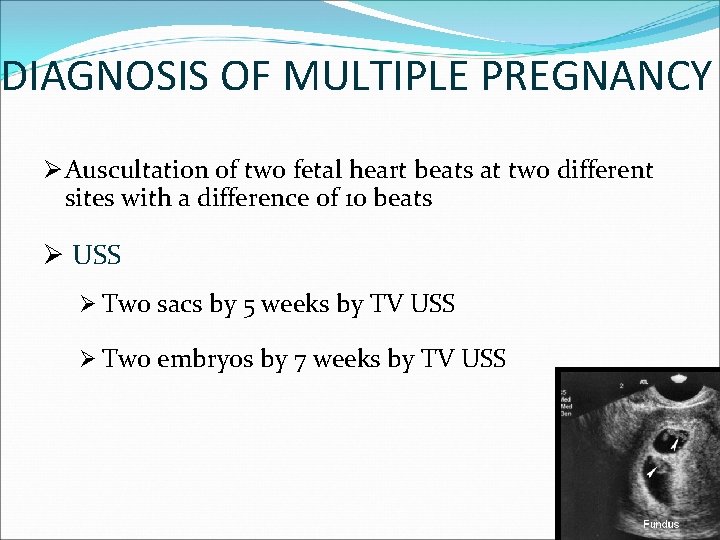 DIAGNOSIS OF MULTIPLE PREGNANCY Ø Auscultation of two fetal heart beats at two different DIAGNOSIS OF MULTIPLE PREGNANCY Ø Auscultation of two fetal heart beats at two different