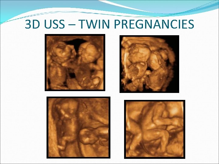 3 D USS – TWIN PREGNANCIES 