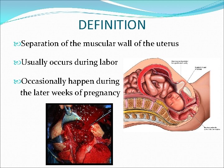 DEFINITION Separation of the muscular wall of the uterus Usually occurs during labor Occasionally