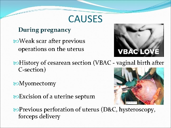 CAUSES During pregnancy Weak scar after previous operations on the uterus History of cesarean