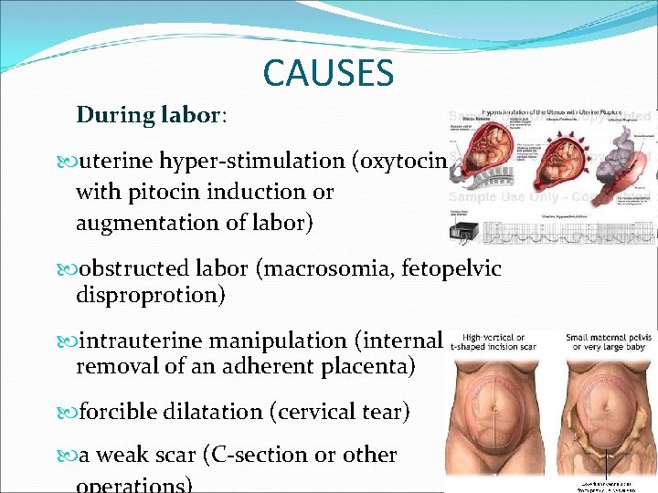 CAUSES During labor: uterine hyper-stimulation (oxytocin with pitocin induction or augmentation of labor) obstructed