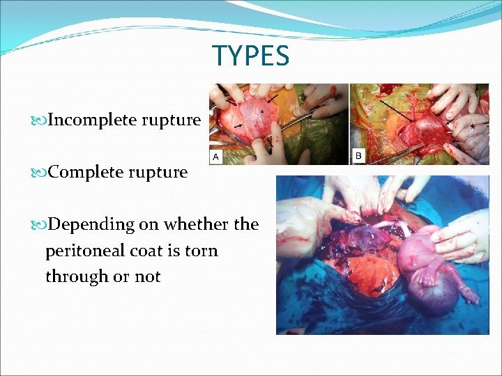 TYPES Incomplete rupture Complete rupture Depending on whether the peritoneal coat is torn through